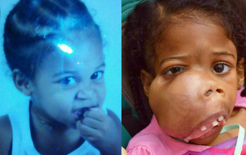 Image on left shows little Tiana before growth of tumour